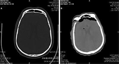 A practical and economical method for frontal sinus reconstruction after frontal craniotomy: A single-center experience with 140 patients